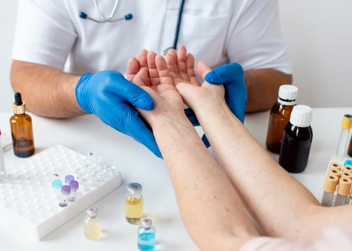 Médico segura a mão de paciente com alergia a medicamentos e verifica as protuberâncias avermelhadas nos braços.