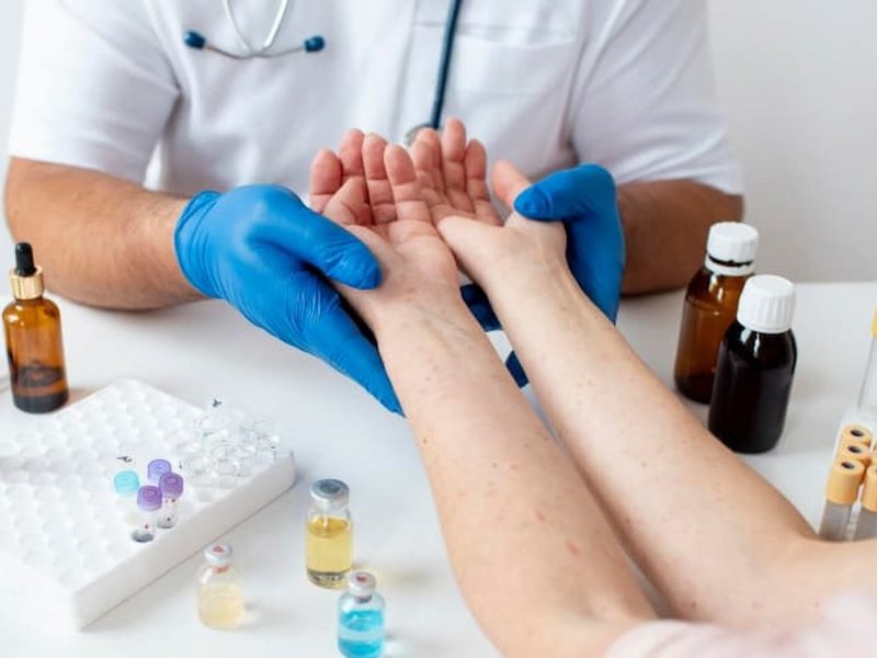 Médico segura a mão de paciente com alergia a medicamentos e verifica as protuberâncias avermelhadas nos braços.
